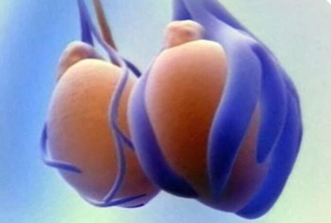 Варикоцела